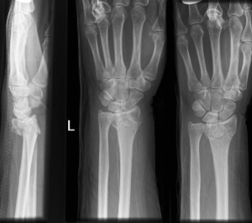 Colles fracture. Lateral (a) and AP (b) wrist radiographs. Transverse