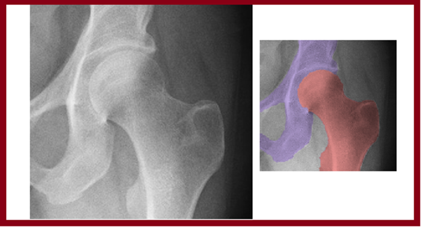 Total Hip Replacement for Hip Arthritis