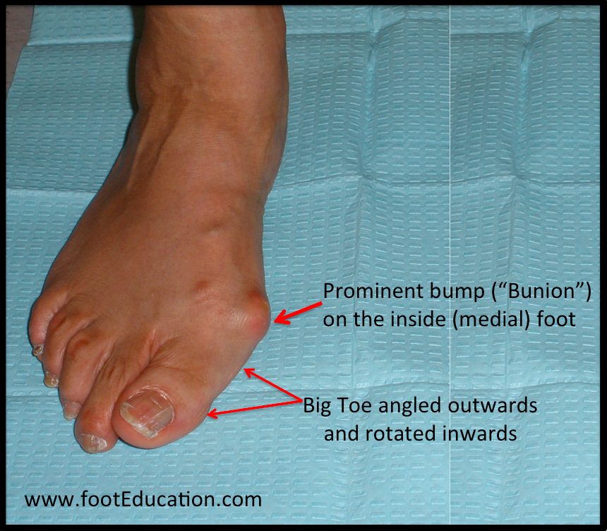 abnormal toe growth